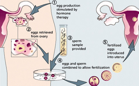 Stages of IVF procedure
