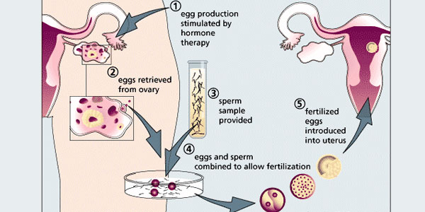 Stages of IVF procedure – BioTexCom – Center for Human Reproduction