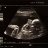 5 amazing things preborn children can do inside the womb