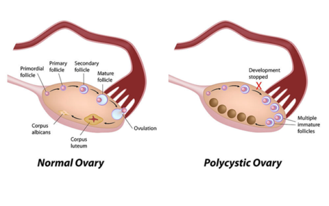 Study finds new class of androgens play key role in polycystic ovary syndrome