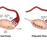 Study finds new class of androgens play key role in polycystic ovary syndrome